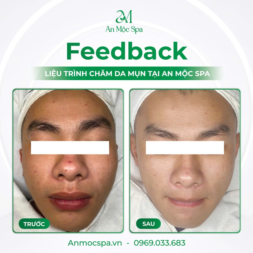 Kết quả lấy nhân mụn tại An Mộc Spa - Trước và Sau