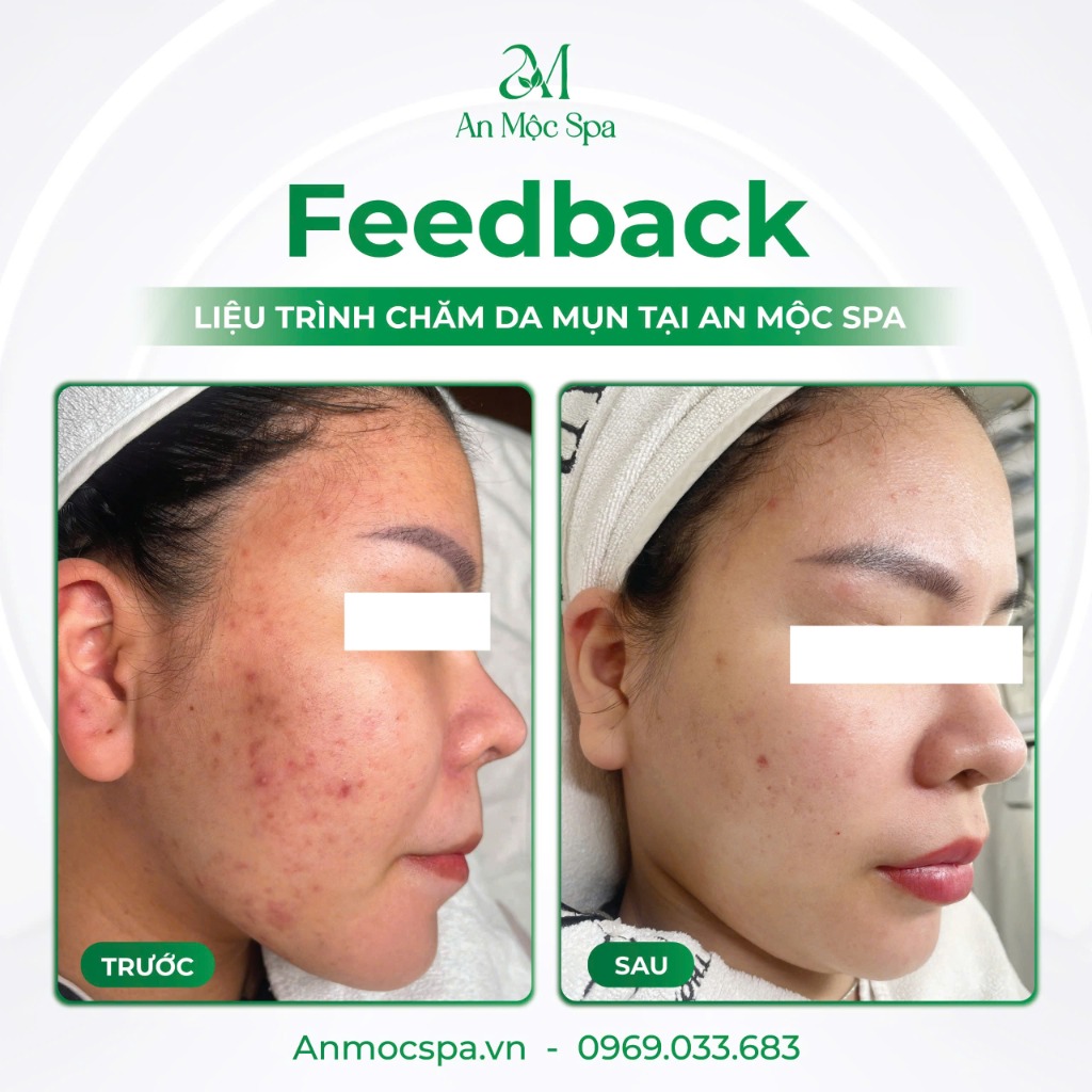 Kết quả trị mụn viêm tại An Mộc Spa - Trước và Sau
